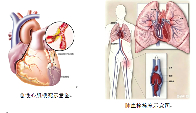 肺栓塞.png